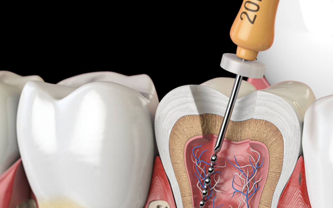Endodontie : sauver vos dents grâce à des soins de haute précision