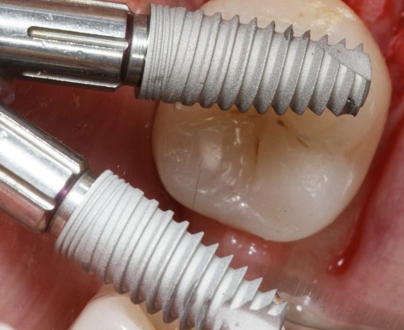 Chirurgie pré-implantaire et greffe osseuse : préparer le terrain pour un implant fiable